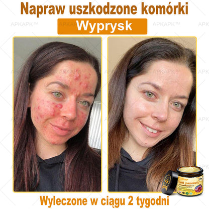 ΑPΚΑPK™Jad Pszczoły Kompleksowy Krem🧑‍⚕️🧑‍⚕️ 🥇pomaga w leczeniu problemów skórnych, takich jak: zmarszczki, blizny, plamy pigmentacyjne, rozstępy, trądzik, łuszczyca, egzema, zmiany skórne, podrażnienia, stany zapalne i inne problemy skórne🔥